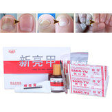 Fingernail Care Treatment Onychomycosis Remover