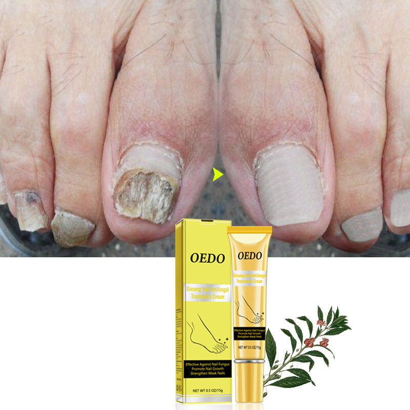 OEDO Nail Repair Treatments Cream Anti Remove Nail Onychomycosis Paronychia Promote Nail Growth Foot Cream Brighten Nail